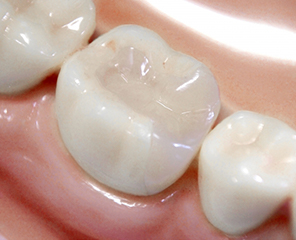 食べかすをためない シーラント