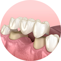 保険適用外の素材