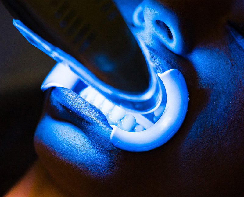 医院で専用機器を使って行う「オフィスホワイトニング」