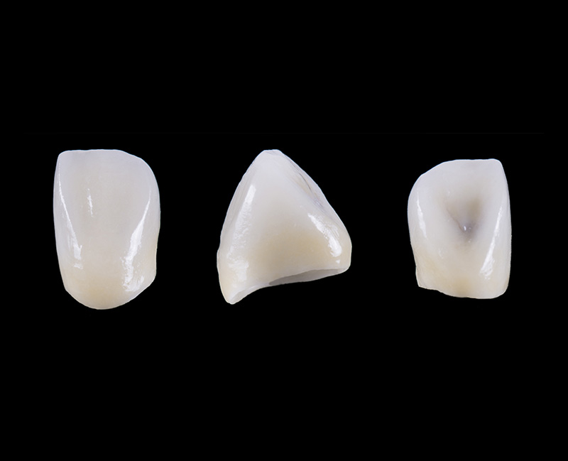 ジルコニアクラウン