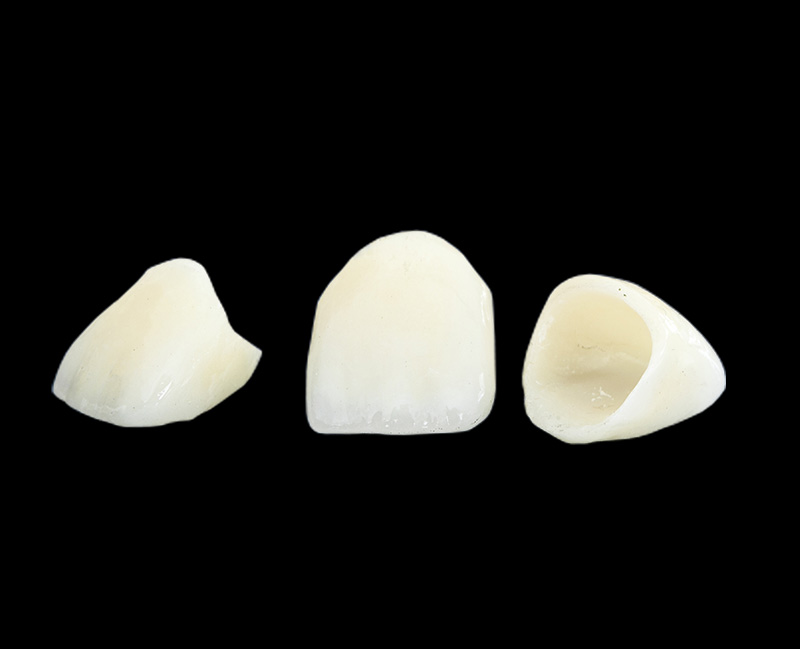 セラミッククラウン