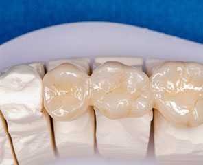 噛み易い・安定的補綴物で修復