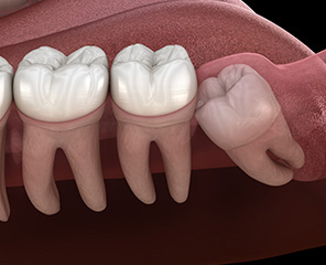 親知らずの抜歯