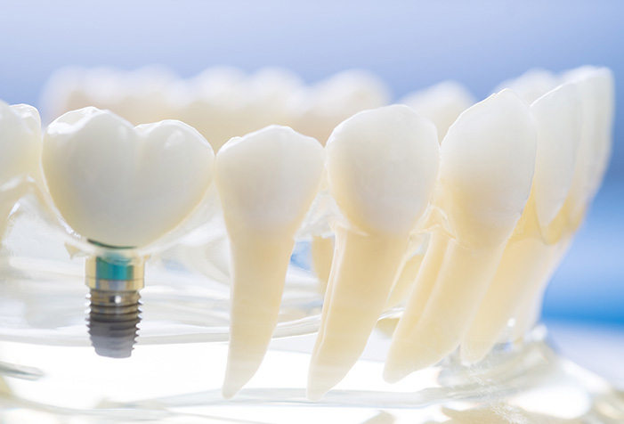 インプラント治療